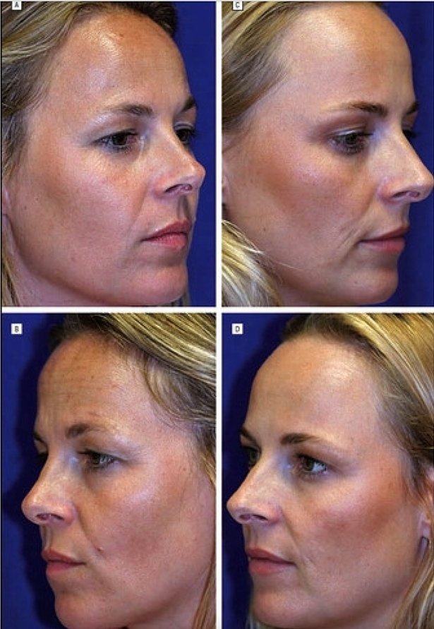 Twins-Get-Botox-2