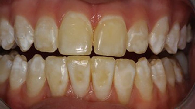 1709-amelogenesis_imperfecta-642x361-hypomaturation_type